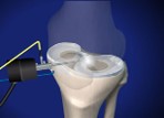 Meniscus Repair Surgery